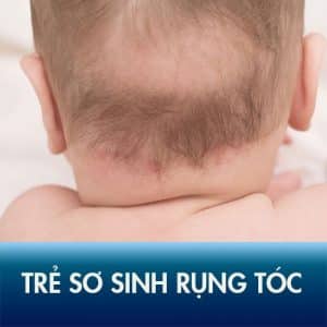 Trẻ sơ sinh bị rụng tóc - nguyên nhân và cách khắc phục [Đầy đủ 2020]11